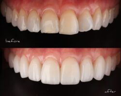 oxnard ca cosmetic dentist before and after