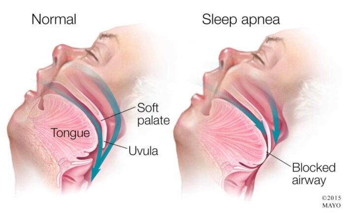 sleep apnea treatment oxnard ca