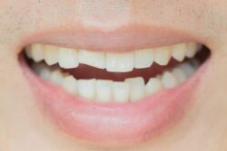 Dental Bonding For Chipped Teeth Oxnard CA