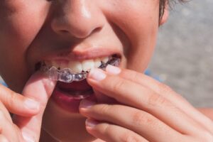 Invisalign Dentistry