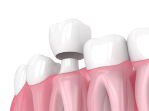 Same-day Dental Crowns in Ventura