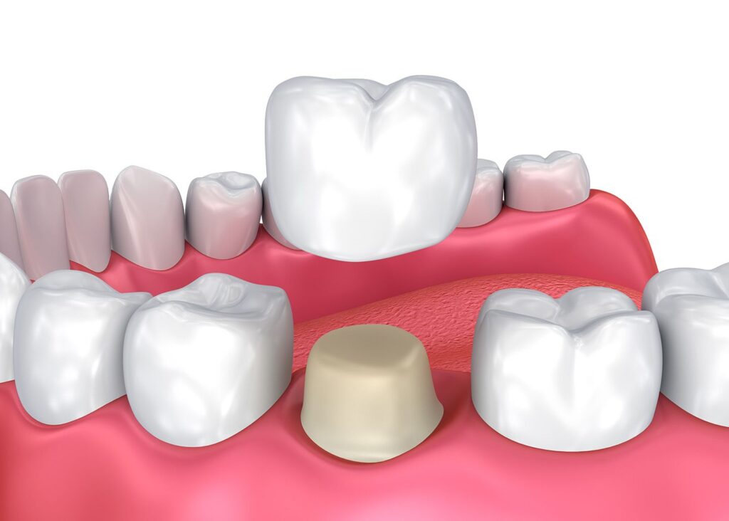Dental Crowns Ventura