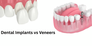 Dental Implants vs Veneers
