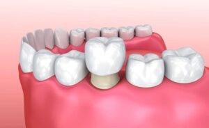Dental Bridges Ventura