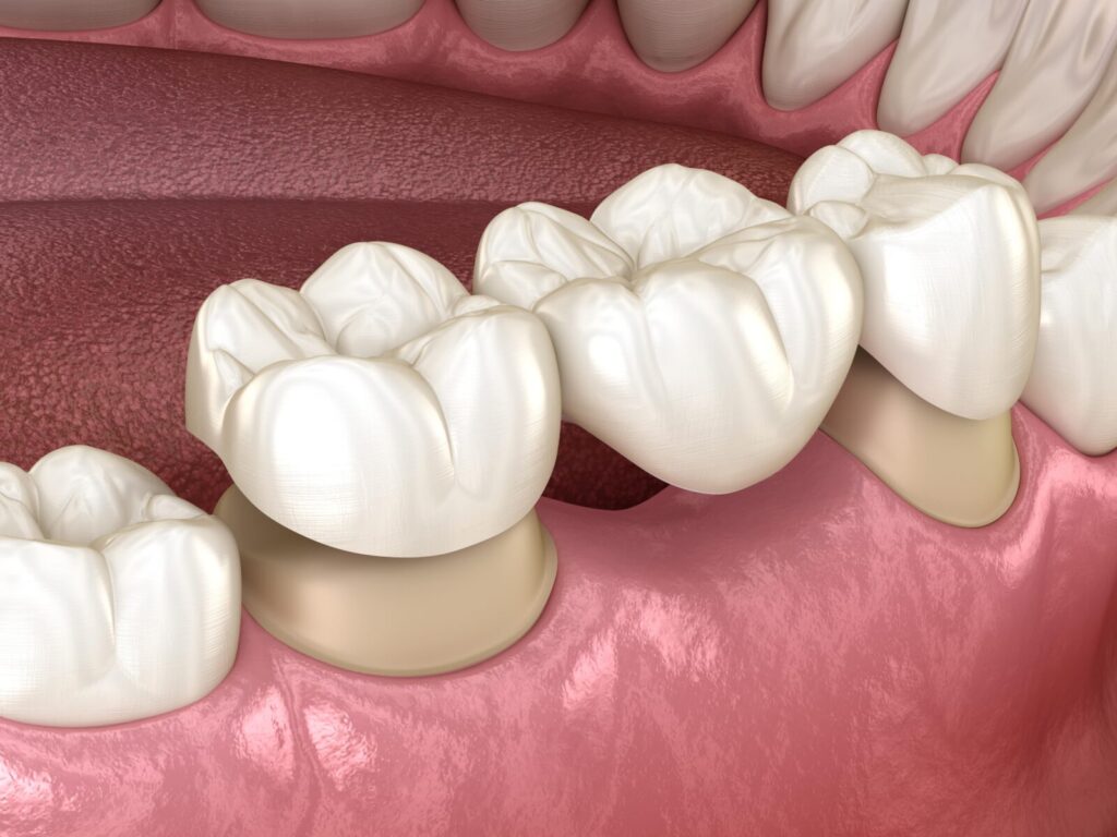 affordable dental bridges Oxnard