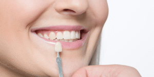 What Are Dental Veneers