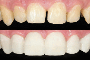 Cosmetic Tooth Bonding