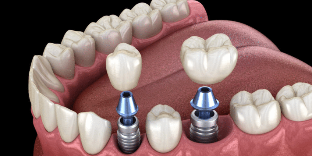 Dental Implants Cost