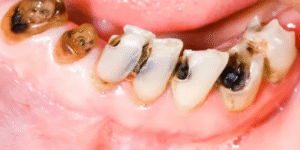 Do Bad Teeth Affect Your Health