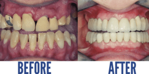 Full Mouth Reconstruction