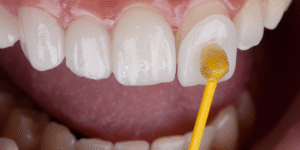 Porcelain Veneers for Chipped Teeth