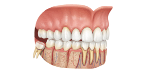 Wisdom Teeth Removal