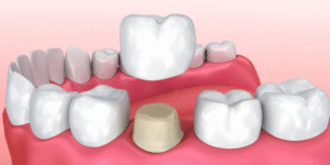 Dental Crowns Cost