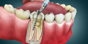 Root Canal Treatment