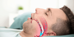 Sleep Apnea Solutions in Ventura