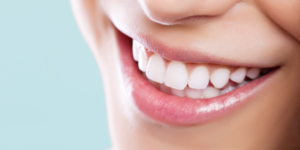 Smile Makeover