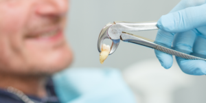 Dry Socket After Tooth Extraction