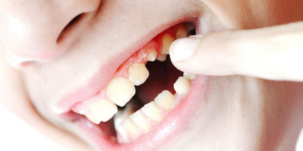 Tooth Broken at the Gum Line