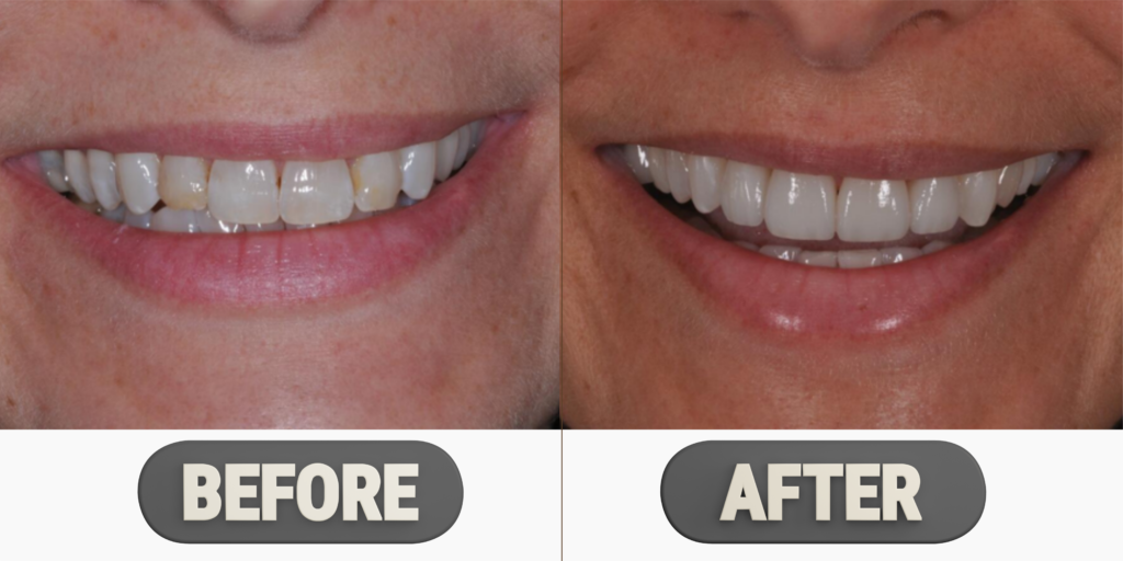 Veneers Before and After