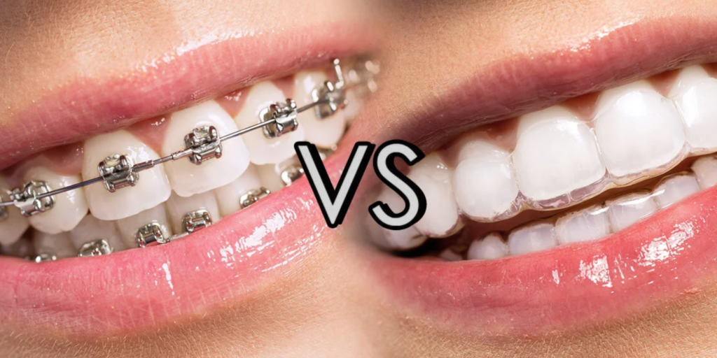 Invisalign vs Braces: Which Is Better for Your Smile?