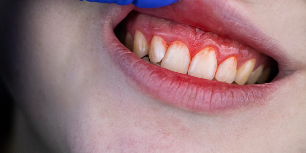 Bleeding Gums Treatment