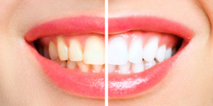 Teeth Whitening Ventura CA