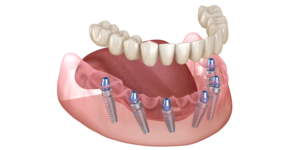 Full Mouth Dental Implants