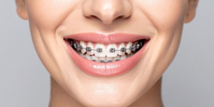 traditional metal braces price