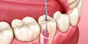 Root Canal Treatment