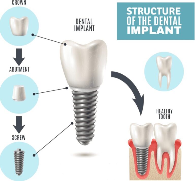 Dental Implant Process