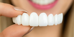 Snap-On and Pop-On Veneers